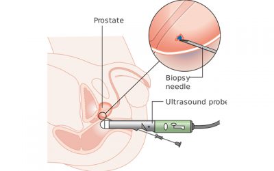 biopsy